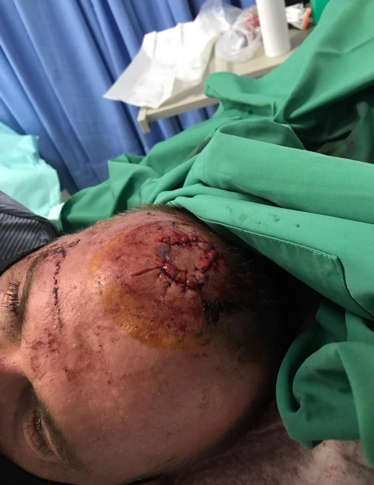 Close-up of a U-shaped run of fresh sutures across the top of a forehead, dressed with antiseptic, taken in a hospital room in Denpasar after a reef hit